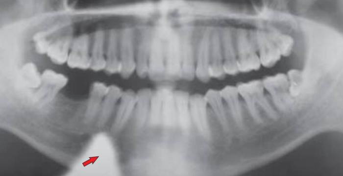 To avoid a lead apron artifact on a panoramic radiograph