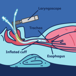 An intubated trauma patient is being transferred